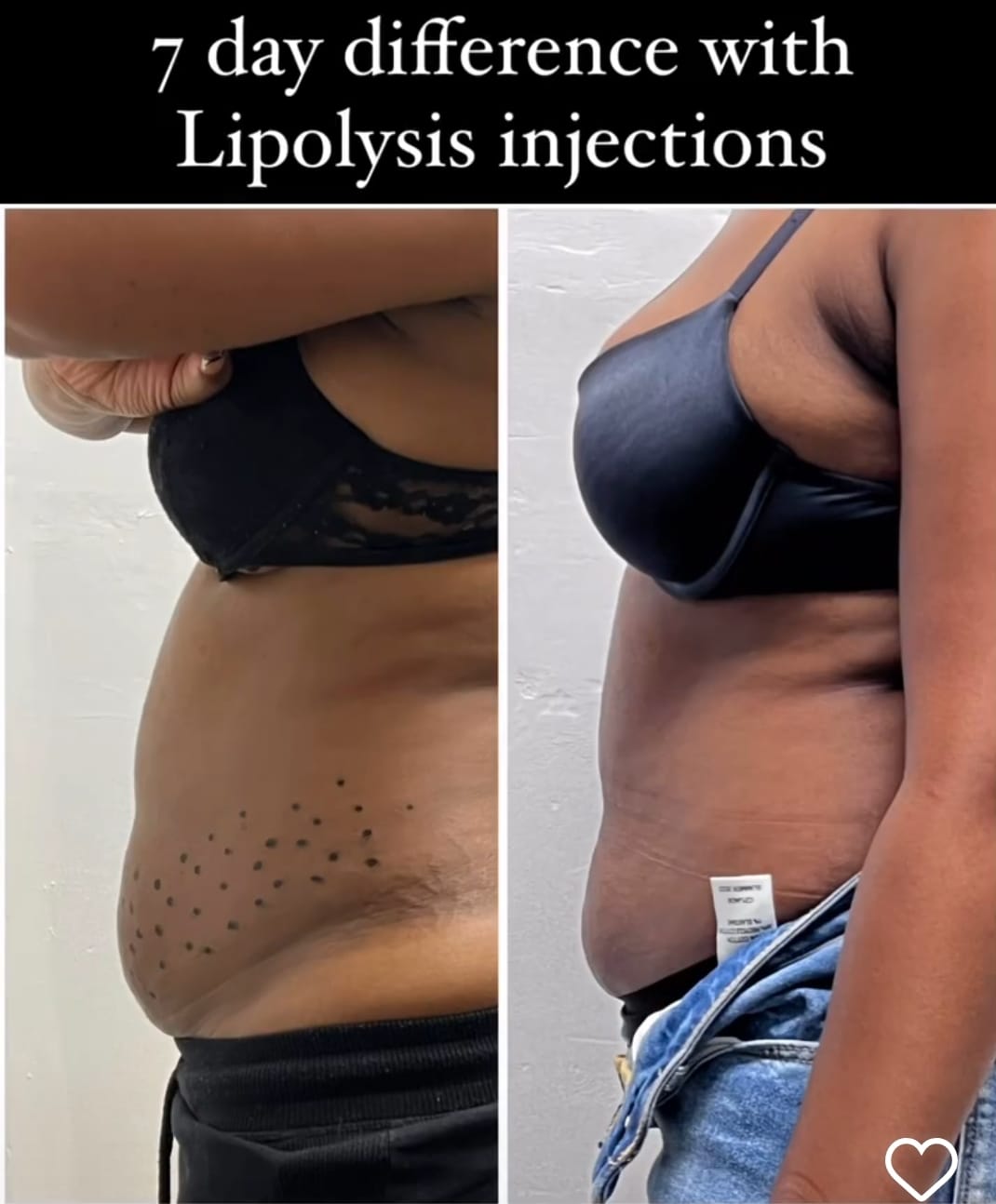 Lipo Vela