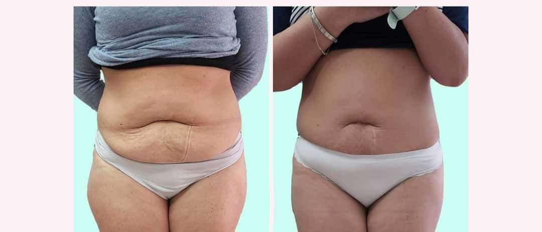 Lipo Vela