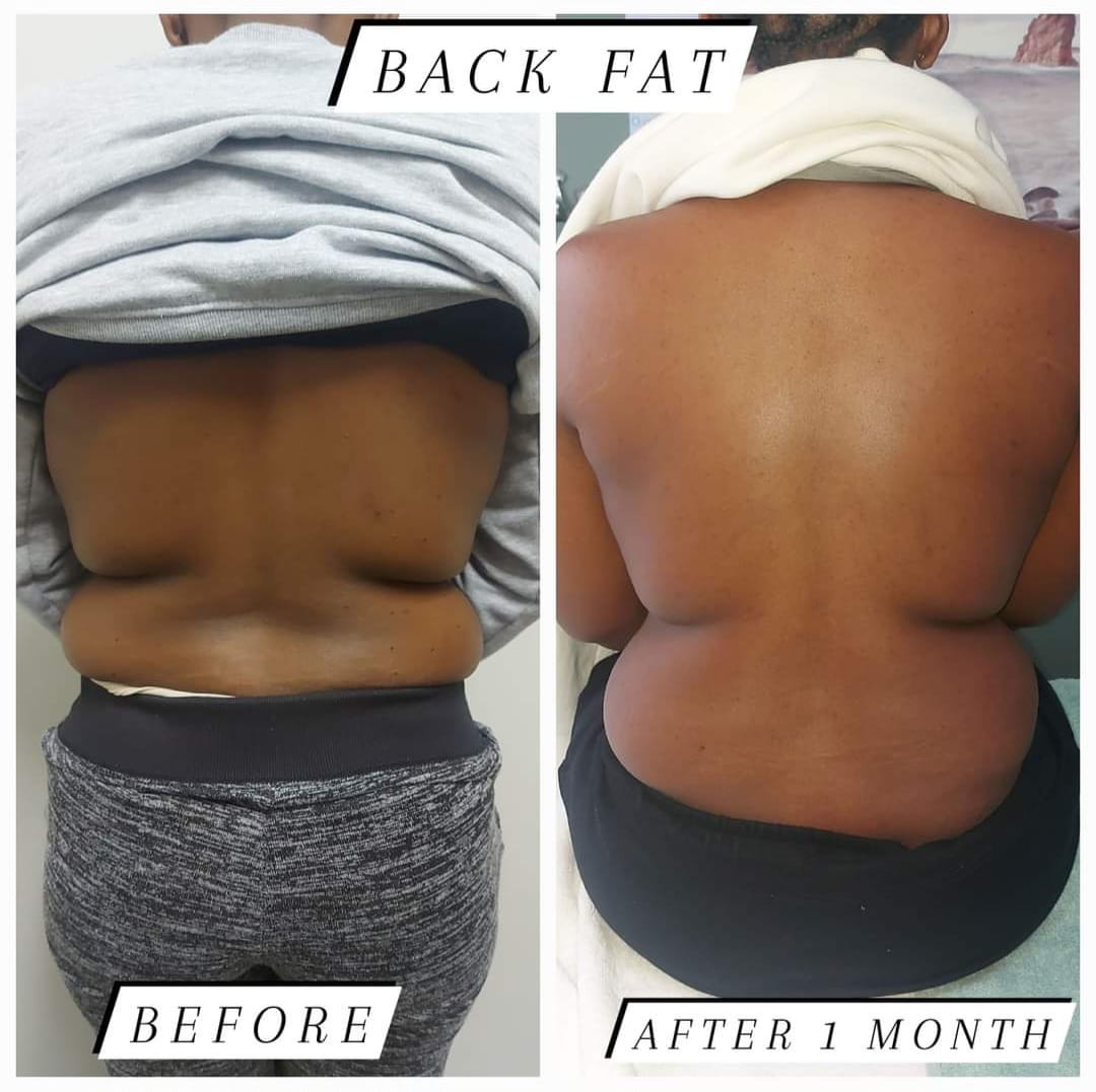 Lipo Vela