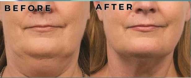 Lipo Vela Vline