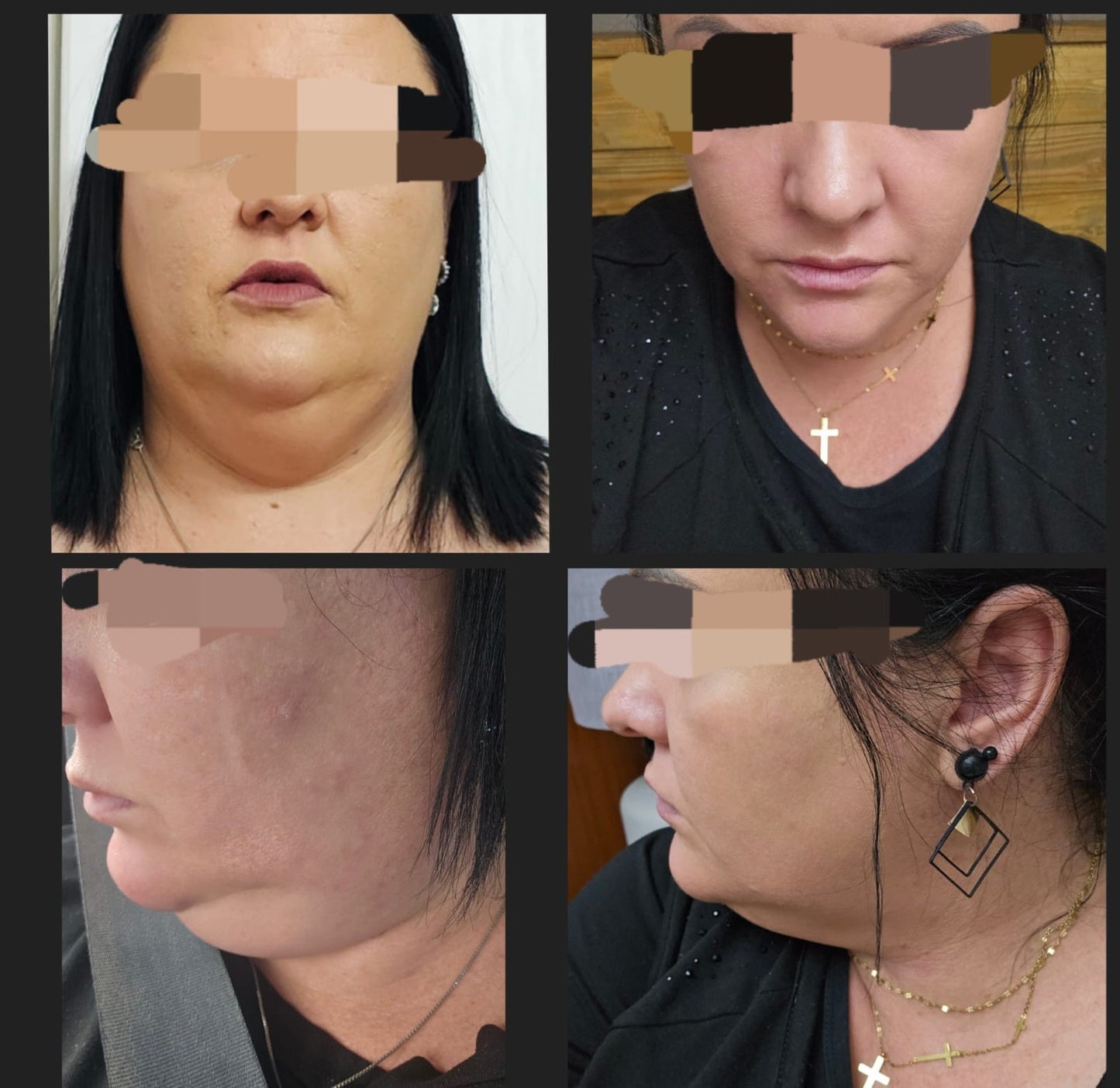 Lipo Vela Vline